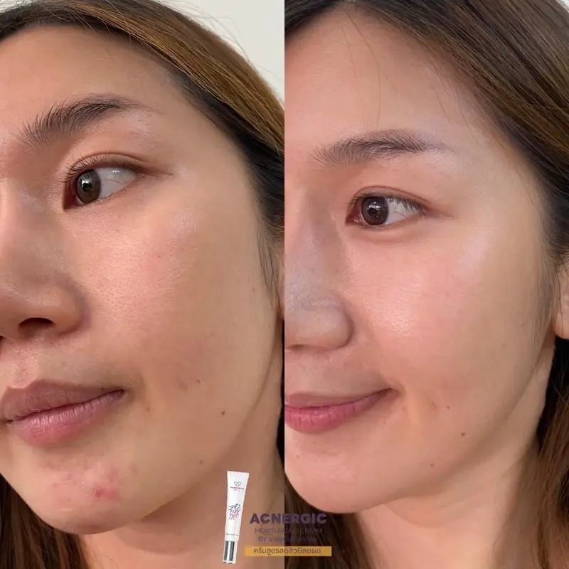 Before & After รีวิวจริงจากผู้ใช้ผลิตภัณฑ์ลดสิว