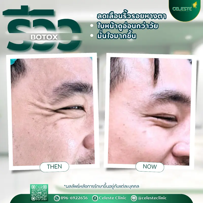 รีวิวโบท็อค เชียงใหม่