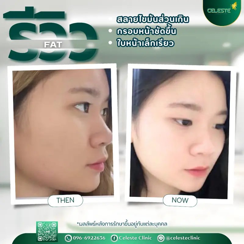 รีวิว FAT