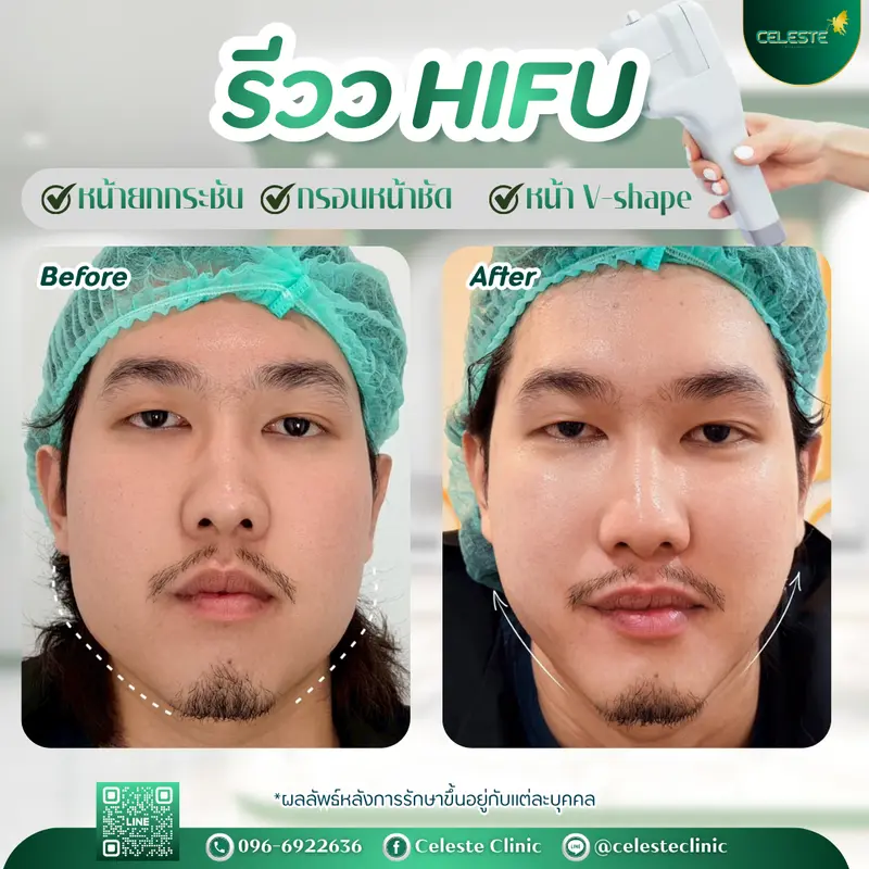 รีวิว HIFU