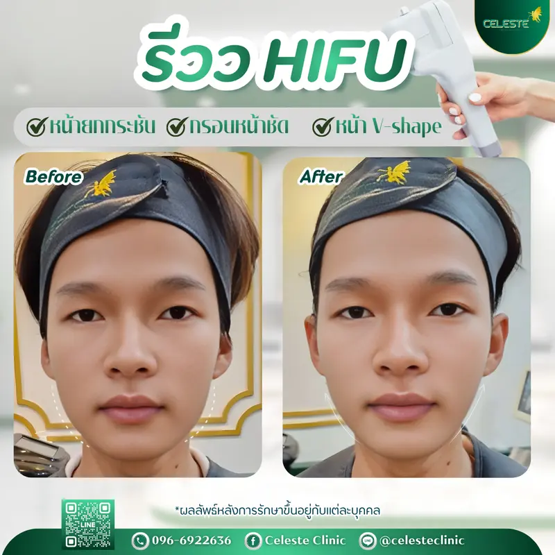 รีวิว HIFU