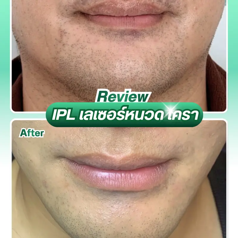 รีวิว เลเซอร์หน้าใส IPL