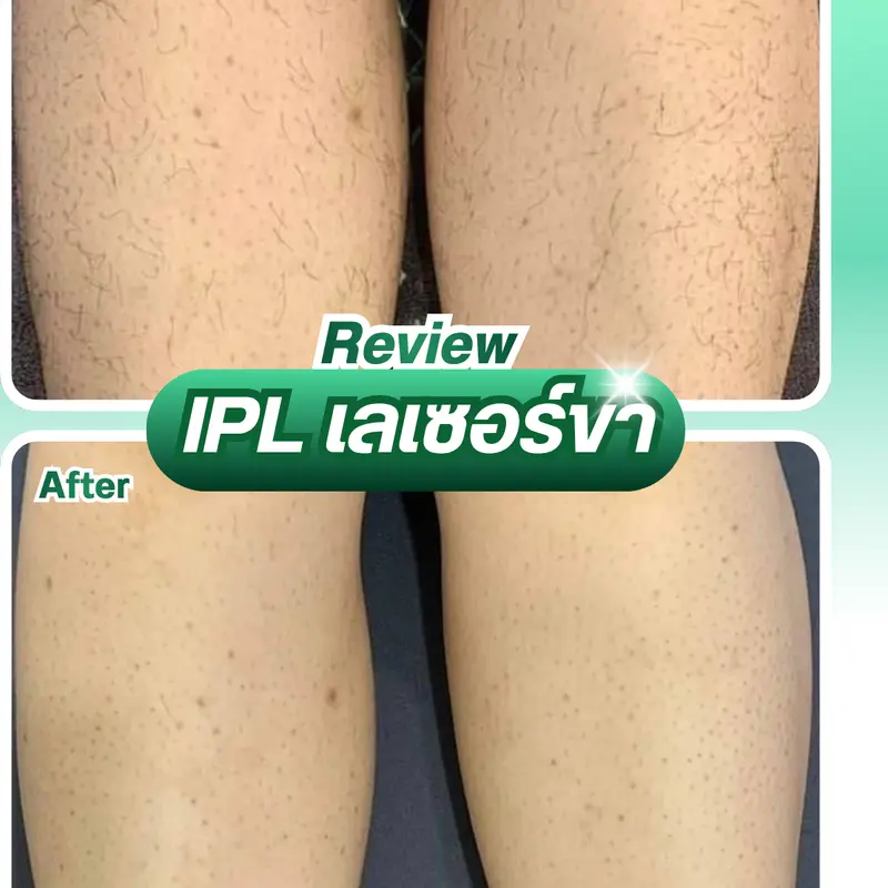 รีวิว เลเซอร์ขา IPL