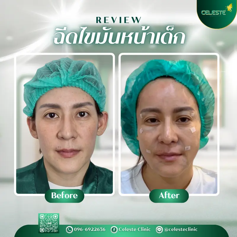ฉีดไขมันหน้าเด็ก