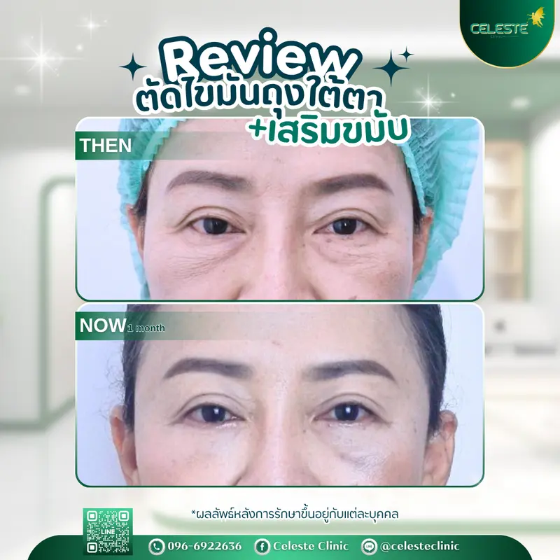 รีวิว ตัดถุงใต้ตา