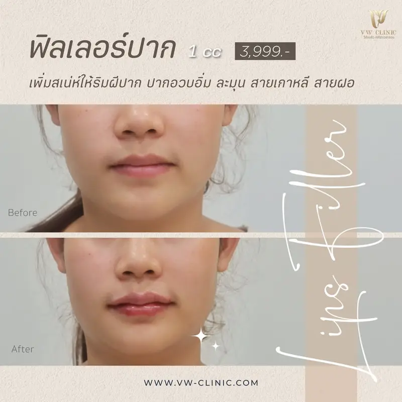 รูปภาพรีวิวฟิลเลอร์ปาก