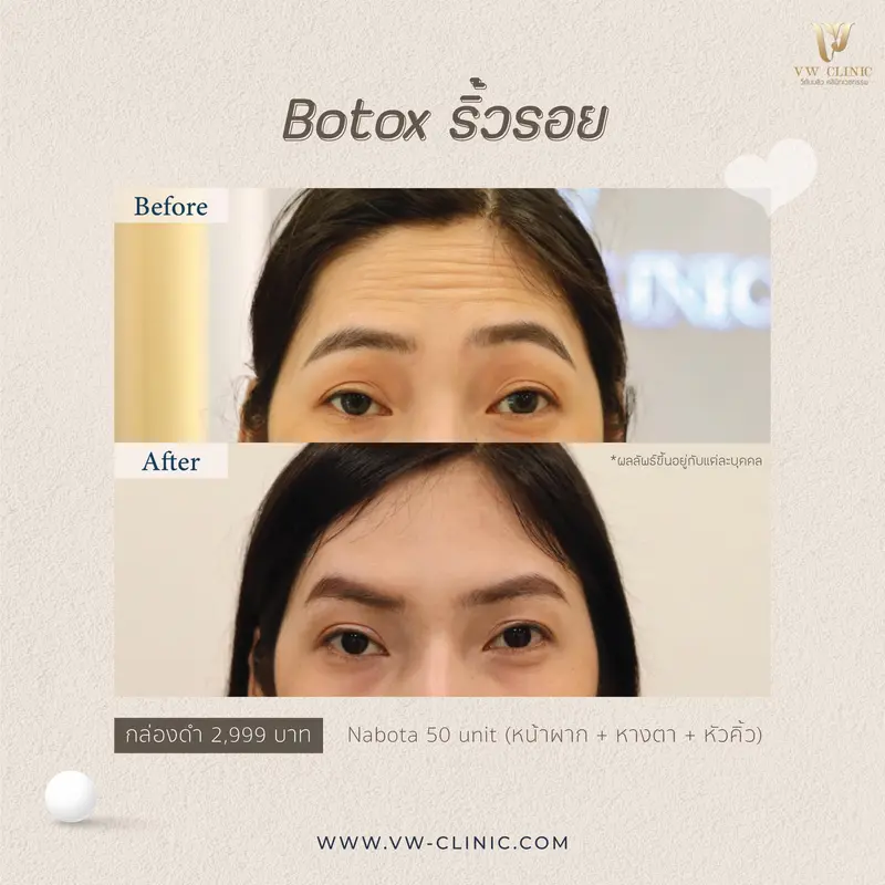 รีวิวโบท็อค ริ้วรอย