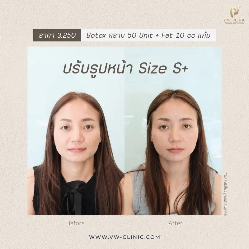 รีวิวปรับรูปหน้า