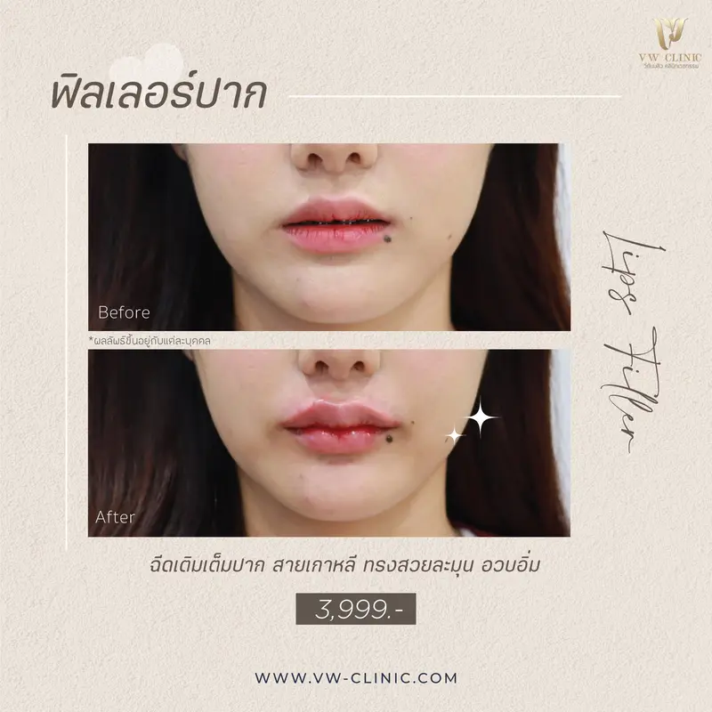 รีวิวฟิลเลอร์ปาก