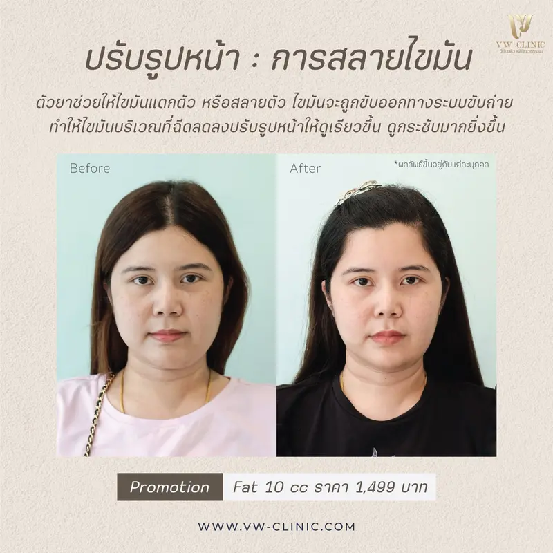 รีวิวปรับรูปหน้า