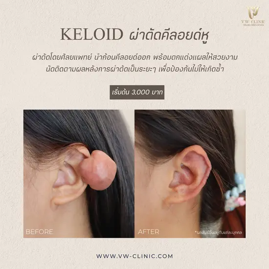 ผ่าตัดคีลอยด์หู ดูแลก้อนนูนจากแผลเจาะหูอย่างเหมาะสม