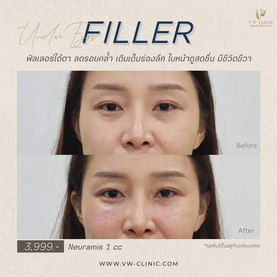 ฉีดฟิลเลอร์เชียงราย ฟิลเลอร์ของแท้ที่ VW Clinic