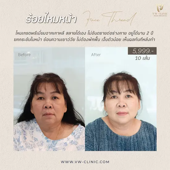 ร้อยไหมหน้า ยกกระชับใบหน้า ลดความหย่อนคล้อยที่ VW Clinic เชียงราย