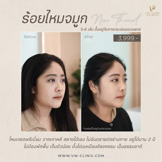 ร้อยไหมจมูกเชียงราย ที่ VW Clinic ร้อยไหมหน้า ลิฟท์กรอบหน้าธรรมชาติ