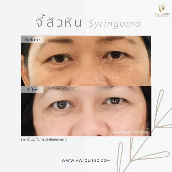 จี้ไฝเชียงราย ที่ VW Clinic ลบติ่งเนื้อ ขี้แมลงวัน ต่อมไขมัน สิวหิน ตาปลา ปลอดภัย