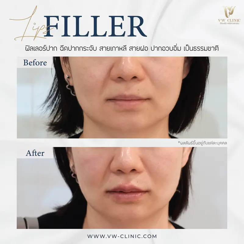 Filler ปาก