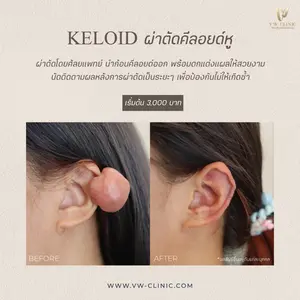 ผ่าตัดคีลอยด์หู ดูแลก้อนนูนจากแผลเจาะหูอย่างเหมาะสม