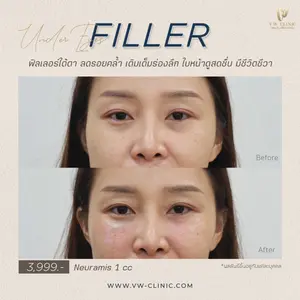 ฉีดฟิลเลอร์เชียงราย ฟิลเลอร์ของแท้ที่ VW Clinic