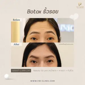 โบท็อกเชียงราย Nabota ของแท้ ลดกราม ลดริ้วรอย ที่ VW Clinic