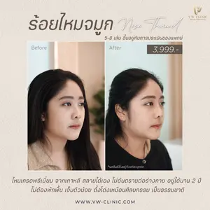 ร้อยไหมจมูกเชียงราย ที่ VW Clinic ร้อยไหมหน้า ลิฟท์กรอบหน้าธรรมชาติ