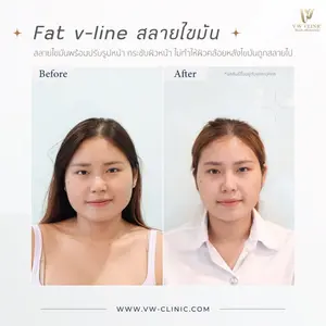 ฉีดแฟตสลายไขมันเชียงราย V-line ลดแก้ม เหนียง ที่ VW Clinic